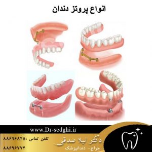 پروتز-دندان
