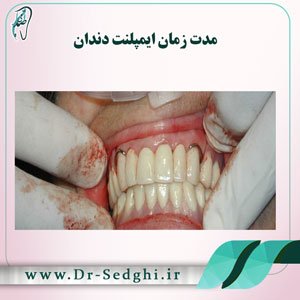 مدت زمان ایمپلنت دندان