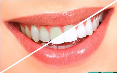 آیا بلیچینگ برای دندان مضر است؟