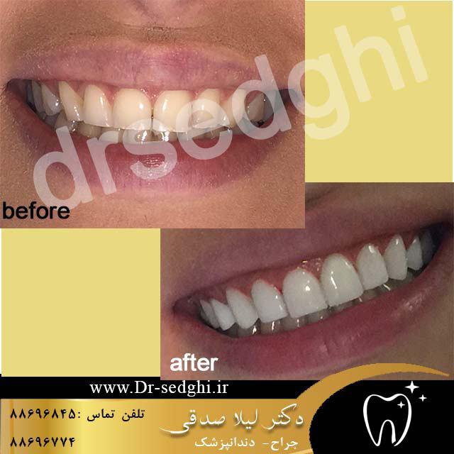 نمونه کارهای دندانپزشکی دکتر لیلا صدقی 5