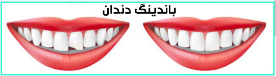 درمان باندینگ دندان چقدر طول می کشد؟