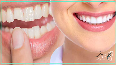 مراحل باندینگ دندان چیست؟