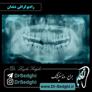 رادیوگرافی دندان
