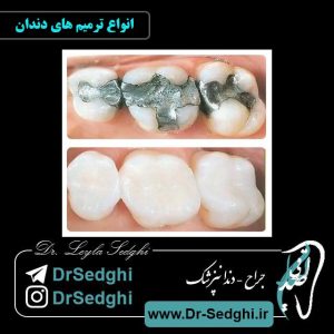 انواع ترمیم های دندان