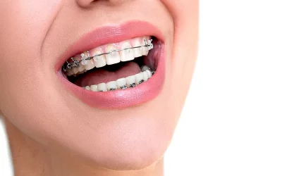 ارتودنسی دیمون؛ مزایا و معایب