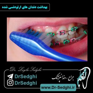 بهداشت دندان های ارتودنسی شده