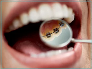 انواع ارتودنسی ثابت دندان چیست؟