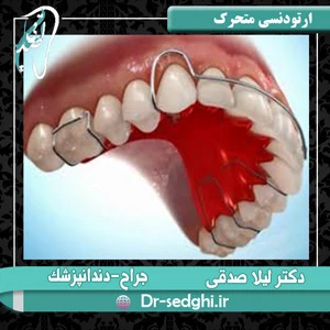 ارتودنسی متحرک دندان