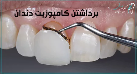آیا می توان کامپوزیت دندان را برداشت؟