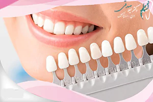 کاربرد کامپوزیت و لمینت دندان چیست؟