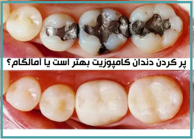 برای پر کردن دندان کامپوزیت بهتر است یا آمالگام؟