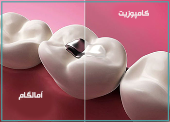 تفاوت آمالگام و کامپوریت برای پر کردن دندان چیست؟