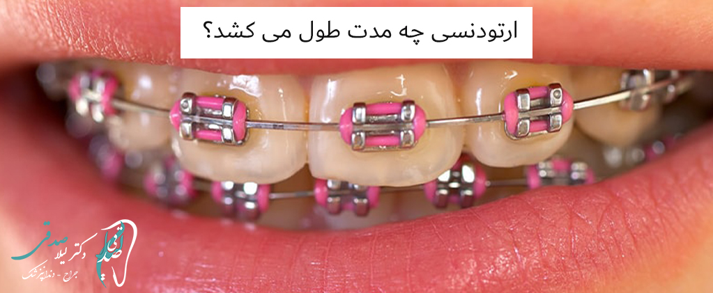 ارتودنسی چه مدت طول می کشد؟