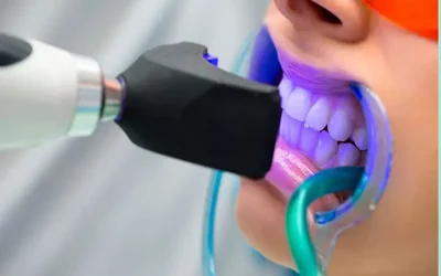 مراحل بلیچینگ دندان