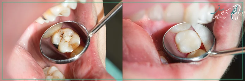 ویژگی های بهترین برند کامپوزیت دندان چیست؟