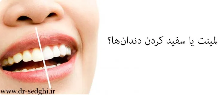 لمینت یا سفید کردن دندان